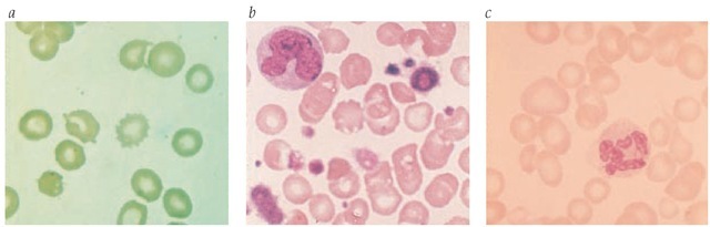 The peripheral smear changes seen in severe liver disease or starvation (a) include distinct variation in size and shape of red blood cells; both sharply spiculed cells (spur cells) and scalloped erythrocytes are prominent. The leukoerythroblastic blood smear (b) indicates marrow replacement with extramedullary hematopoiesis. It is characterized by variation in the size and shape of red blood cells, by the presence of nucleated red blood cells in the peripheral blood, by giant platelets, and by immaturity in the myeloid series. In folic acid or cobalamin deficiency (c), the smear is characterized by variation in erythrocyte size and by distinct macrocytosis. Occasionally, fish-tailed erythrocytes are present, along with hypersegmented neutrophils.