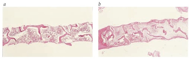 Shown are (a) biopsy of normal bone marrow and (b) biopsy of bone marrow from a patient with aplastic anemia showing almost complete aplasia.