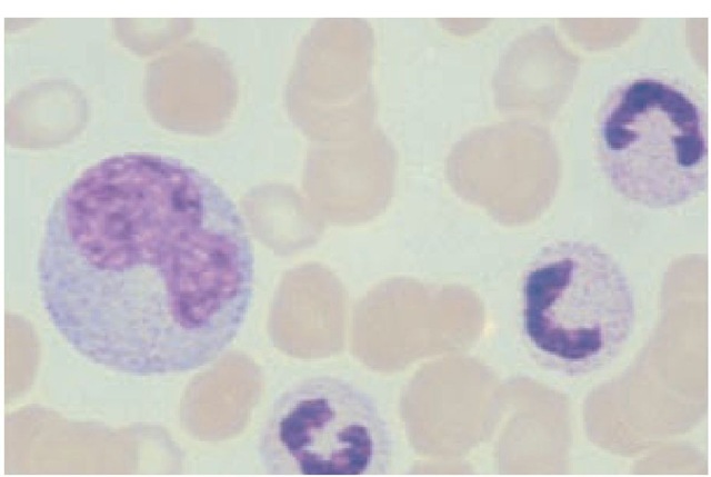 A monocyte (large cell at left), which can reach 17 m in diameter, has abundant basophilic cytoplasm and a large eccentric nucleus.