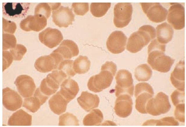 In this thin Wright stain of peripheral blood from a patient in the febrile stage of relapsing fever, several spirochetes can be seen.