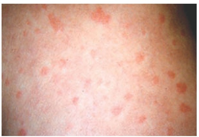  Lesions of generalized urticaria tend to be symmetrical and sometimes have a halo of pallor surrounding the wheal.