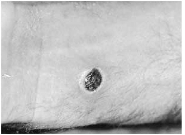 Typical dark, necrotic, painless pruritic skin lesion of anthrax on the wrist of a shepherd from Morocco.