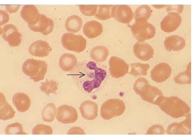 In a peripheral blood smear from a patient with human granulocytic ehrlichiosis, a typical round ehrlichial morula is seen at the center of the neutrophil, adjacent to the nuclear lobes (arrow). Two platelets can be seen below and to the right of the neutrophil, for comparison. Wright-Giemsa stain was used; original magnification: x 370. 