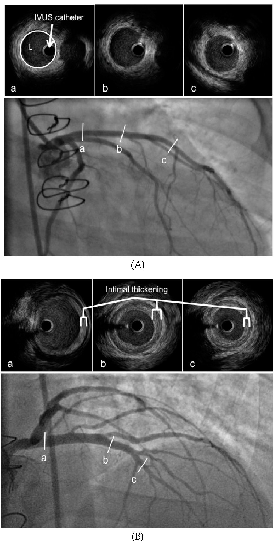 Angiography and IVUS imaging demonstrating (A) normal coronary arteries and (B) cardiac allograft vasculopathy. (L= coronary artery lumen). 