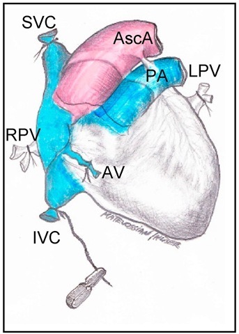Depiction of vascular ligatures at the donor's heart for organ harvesting 