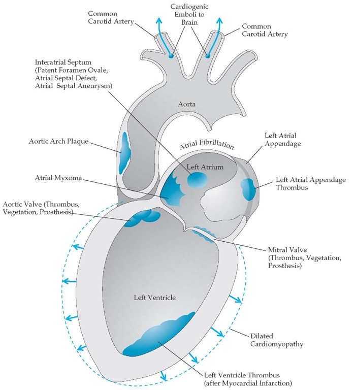 Potential sources of cardioembolism. 