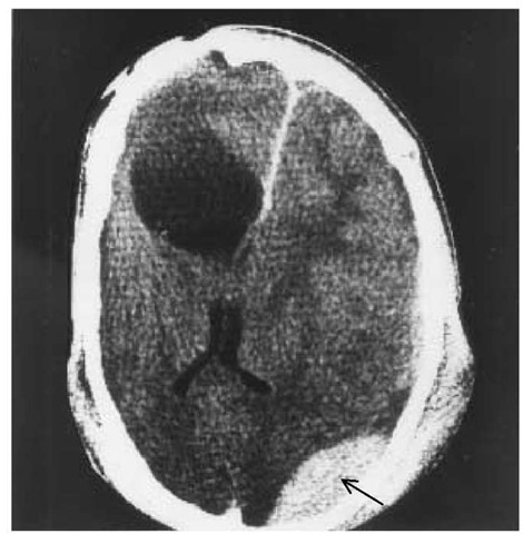  CT in a 19-year-old man with a history of head injury and recent occipital injury shows the old lesion, the resulting midline distortion, and an epidural hematoma (arrow) resulting from the recent injury.