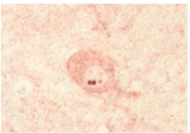 Aggregates of ataxin 3 are visible within the nucleus of a pontine neuron from a patient with Machado-Joseph disease.