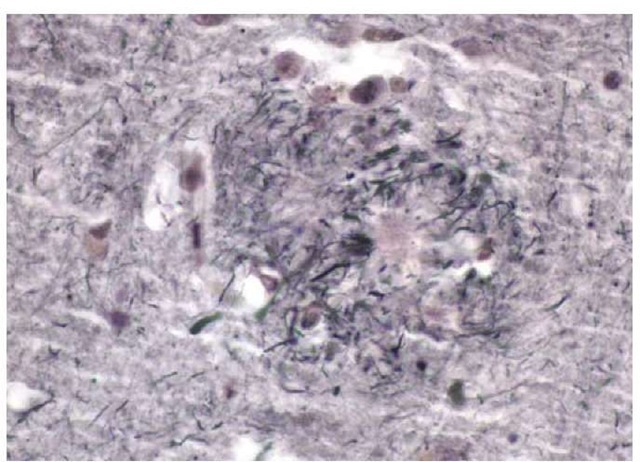 Photomicrograph of a neuritic plaque in the cortex of a patient with Alzheimer disease.