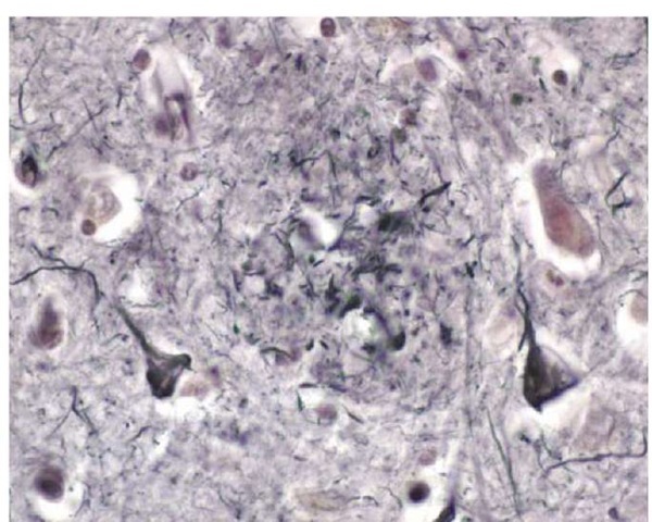 Photomicrograph of several neurons containing neurofibrillary tangles from the cortex of a patient with Alzheimer disease.