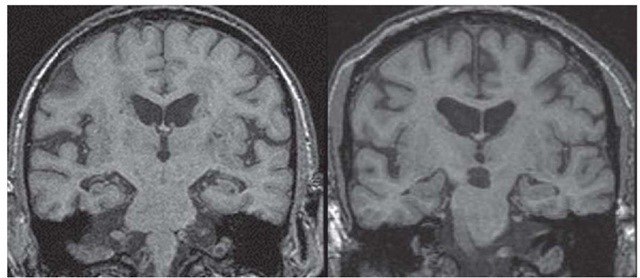 Coronal MRI scan demonstrating hippocampal atrophy in a patient with clinically diagnosed Alzheimer disease (left), compared with a scan of a normal person of comparable age (right).