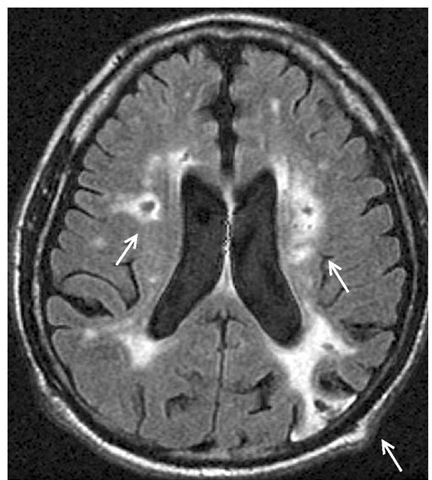 MRI scan of a patient with vascular dementia showing multiple infarcts (arrows): one parieto-occipital cortical infarct and two white-matter infarcts.