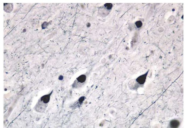 Photomicrograph of Pick bodies, a feature of a frontotemporal lobar degeneration involving abnormalities of the tau protein.