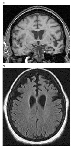  MRI scan of focal temporal (a) or frontal atrophy (b) in patients with frontotemporal lobar degenerations.