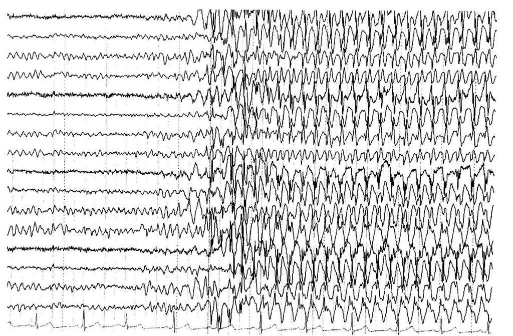 Electroencephalogram obtained from electrodes affixed to the patient's scalp and reformatted with analog-to-digital conversion. The normal background patterns are interrupted by generalized polyspike and then spike and slow-wave discharges at 3/sec. This EEG is typical for that recorded from patients with childhood absence epilepsy. The dark vertical lines denote 1 second; the sensitivity is 7 ^V/mm.