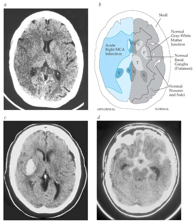  (a) Early computed tomographic findings in acute ischemic stroke. Three hours after onset of left hemiparesis and neglect, this noncontrast CT scan reveals extensive early findings in the right hemisphere, including obscuration of the gray-white junction and the basal ganglia and effacement of the cortical sulci. (b) Detail of CT findings shown in panel a. (c) Noncontrast head CT scan of a right putamenal intracerebral hemorrhage. (d) Noncontrast head CT scan of a subarachnoid hemorrhage manifesting the classic star-shaped area of hyperdensity in the basal cisterns. (C—caudate nucleus; P—putamen; T—thalamus; V—ventricles) 