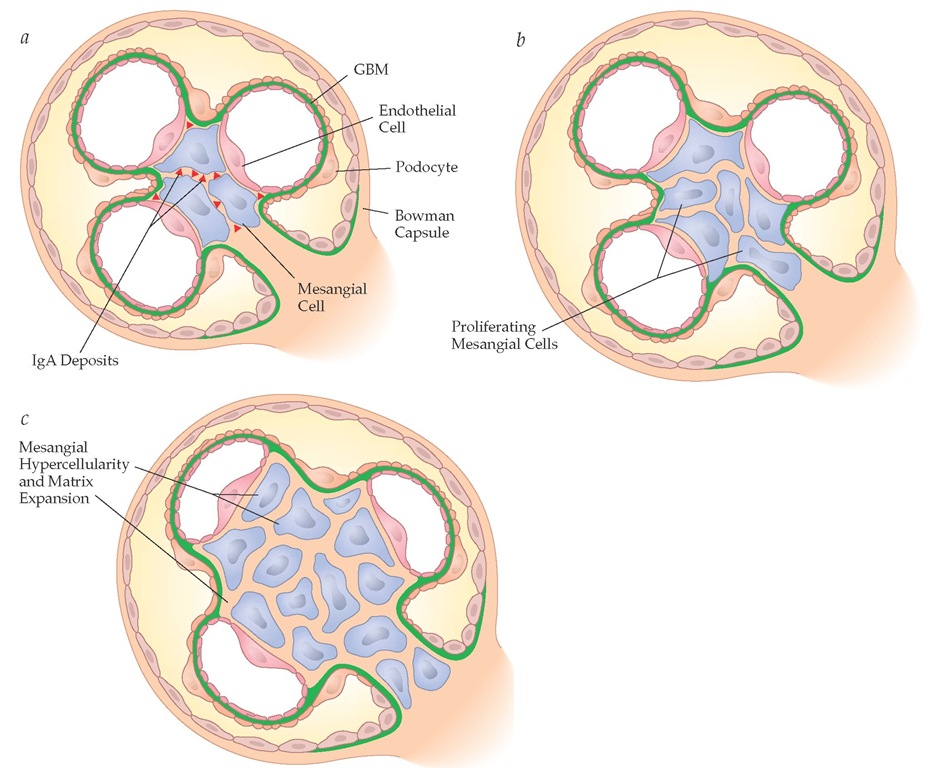 Schematic view outlining the events in IgA nephropathy leading to mesangial hypercellularity and matrix expansion. (a) IgA deposition between mesangial cells is followed by (b) proliferation of mesangial cells, which leads to (c) mesangial hypercellularity and matrix expansion.