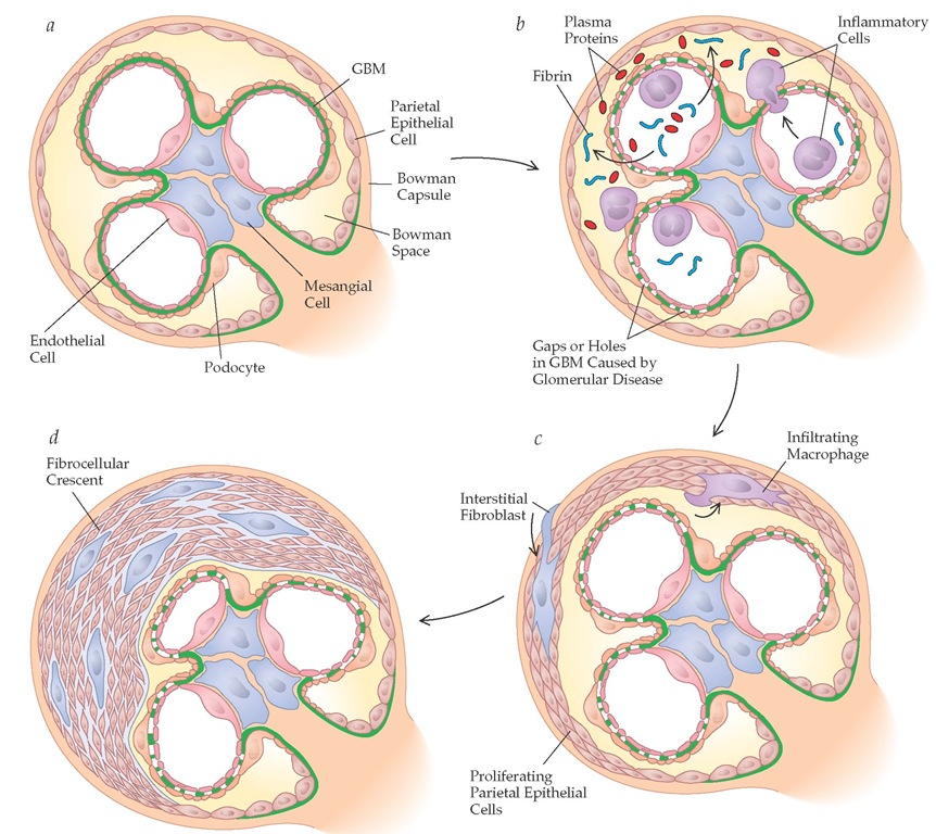 Schematic view illustrating the events leading to crescent formation. (a) Normal glomerulus. (b) Glomerular disease leads to gaps or holes in the glomerular basement membrane (GBM), resulting in (c) proliferation of parietal epithelial cells and ultimately (d) fibrocellular crescent formation.