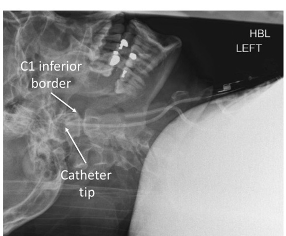 Lateral radiograph of the cervical spine showing a jugular bulb catheter positioned with its tip cephalad to the inferior border of the first cervical (C1) vertebra. 