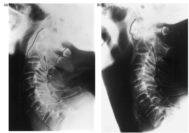 Non-union of a fracture of the dens. (a) Satisfactory vertebral alignment in extension; (b) subluxation of C1 on C2 during neck flexion, resulting in severe spinal canal compromise. 