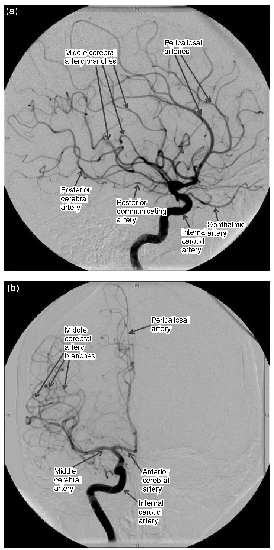 Subtraction angiogram ofthe internal carotid circulation. (a) Lateral projection; (b) anteroposterior projection.  