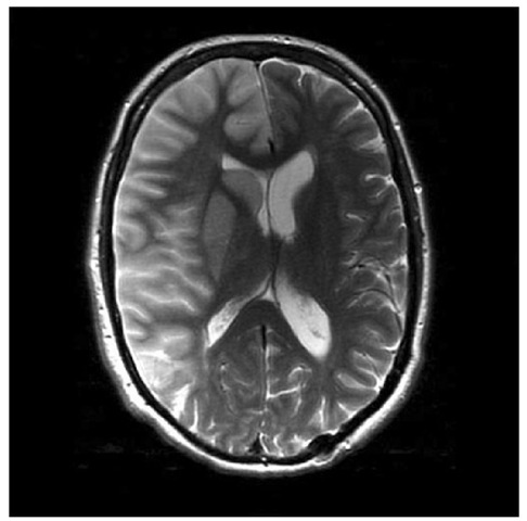 Right middle cerebral artery (MCA) territory pathology. MRI brain scan demonstrating oedema following an infarct in the MCA territory. 