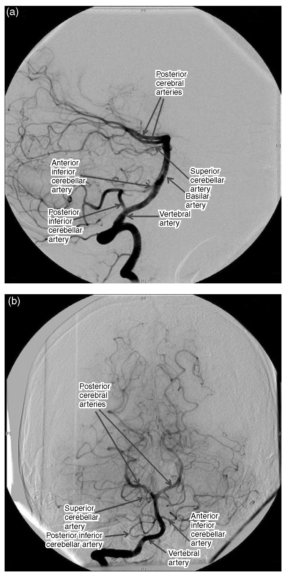 Subtraction angiogram oft he vertebral circulation. (a) Lateral projection; (b) anteroposterior projection. 