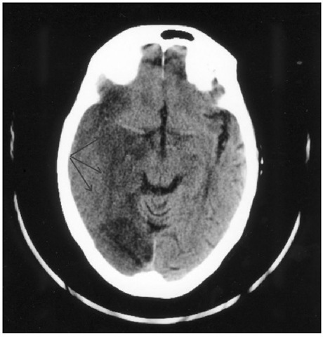 CT head scan showing extensive infarction (lowdensity) in the territory of the posterior cerebral artery (arrows). This was the result of compression of the vessel at the tentorial hiatus due to uncal herniation. 