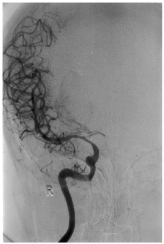 Vasospasm in the A1 segment due to an AComA aneurysm. Only the right anteroposterior (MCA) territory fills following right internal carotid artery (ICA) angiography. In this instance, the circle of Willis would be unable to maintain right MCA blood flow if perfusion were to be reduced in the ipsilateral ICA. R, right side. 