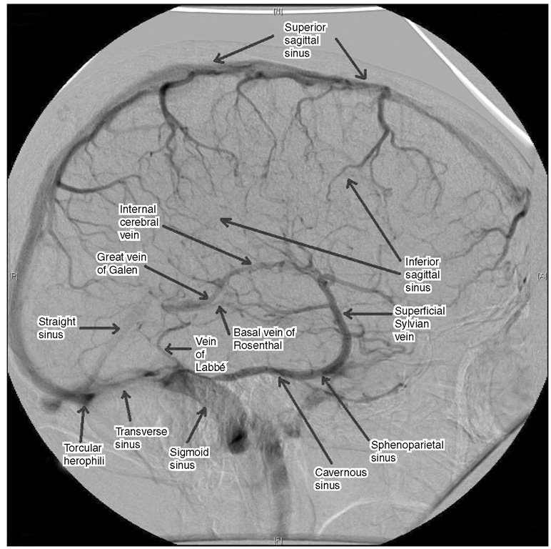 The major superficial and deep venous drainage of the brain on venous phase angiography. 