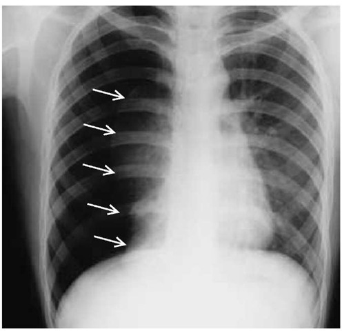 This chest radiograph of a patient with pneumothorax demonstrates virtually complete collapse of the right lung. There has been a slight shift of the mediastinum toward the contralateral side. The visceral pleura (arrows) can be clearly identified because gas is present on both sides. 