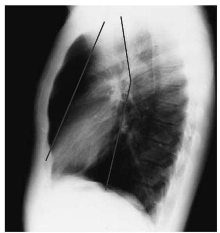 Lines drawn on this normal lateral chest x-ray mark the theoretical division of the mediastinum into anterior, middle, and posterior compartments. Focal abnormalities of the mediastinum can be identified as occurring predominantly in one compartment or another, facilitating differential diagnosis. 