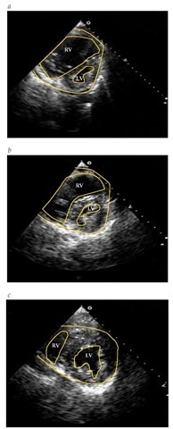 (a) Echocardiogram of a patient with chronic pulmonary hypertension. (b) Echocardiogram of a patient with acute pulmonary hypertension. (c) Echocardiogram of the patient shown in Figure B after clot lysis. (LV—left ventricle; RV—right ventricle) 