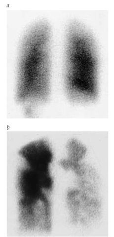 Perfusion lung scans of a patient with primary pulmonary hypertension showing homogeneous perfusion (a) and of a patient with chronic thromboembolic pulmonary hypertension, showing large bilateral perfusion defects (b) 