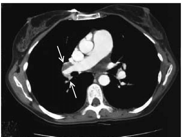 Spiral CT scan of the chest of a patient with chronic thromboembolic pulmonary hypertension showing large defects in the right main pulmonary artery (arrows). 