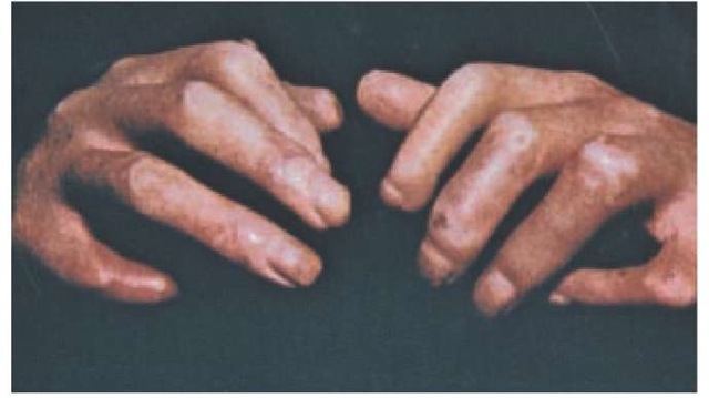 Severe involvement of the hands in a patient with longstanding scleroderma includes flexion contractures of the fingers related to fibrosis of the skin and of subcutaneous tissues. Increased pigmentation has occurred, and melanin loss (vitiligo) is evident in some areas. The distal aspects of the terminal phalanges in some fingers have undergone resorption or shortening. This process, termed autoamputation, usually occurs without ulceration of the terminal digit; the mechanism is unknown.