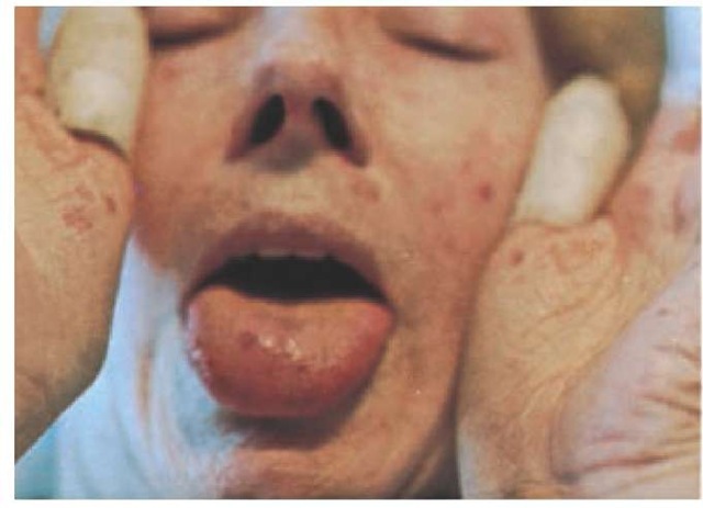 Telangiectasias appear on the hands, face, and tongue in a patient with the CREST (calcinosis, Raynaud phenomenon, esophageal involvement, sclerodactyly, and telangiectasias) variant of scleroderma. Thumbs are bandaged because of chronic ulcerations associated with the Raynaud phenomenon. 