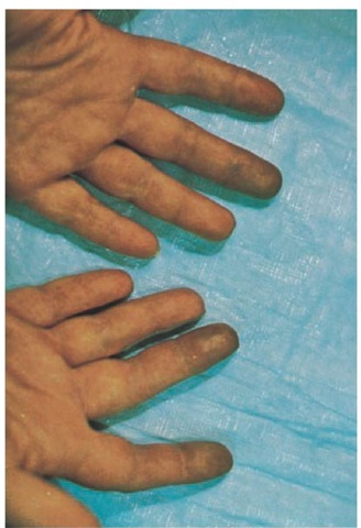 Vascular pathology usually manifests itself as the Raynaud phenomenon in patients with scleroderma. The cyanotic phase of the Raynaud phenomenon often involves the distal two thirds of the second and third fingers of both hands. 