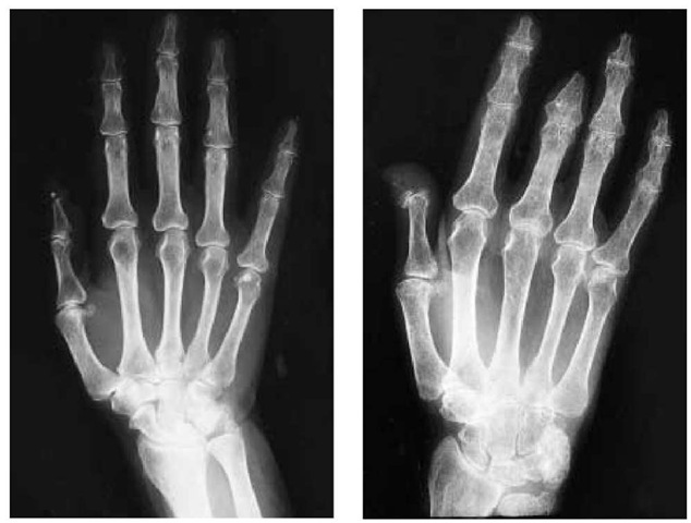 Over an 8-year period, radiographs taken of the hand of a patient with scleroderma demonstrate a progressive, terminal resorption of the digits. The earlier film (left) shows a loss of the spherical terminal portion of the distal phalanx of the thumb and a small, dense calcific deposit at the terminal aspect of the thumb. After an 8-year period, dramatic changes can be seen (right). An almost complete loss of the terminal phalanx of the thumb and a partial loss of the distal phalanges of the remaining fingers are observed. In addition, the entire distal phalanx of the third finger is lost along with part of the middle phalanx. Loss of the middle phalanx is less common than loss of the distal phalanges. A generalized osteopenia is present in the later stage, which is probably related to osteoporosis of disuse, and a calcific deposit has formed in the ulnar aspect of the wrist. The apparent narrowing of interphalangeal joint spaces may be associated with flexion contractures of the fingers, which are caused by the fibrous thickening of the connective tissues of the hand.  
