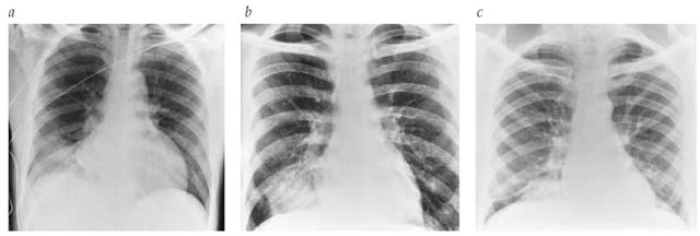  (a) Unlike common bacterial pneumonias, Mycoplasma pneumonia frequently involves one or more specific segments. In this chest radiograph of a 42-year-old man, Mycoplasma pneumonia involves the anterior basal segment of the right lower lobe. (b) This chest radiograph of a 24-year-old man demonstrates a carcinoid tumor obstructing the medial basal segment of the right lower lobe. (c) Allergic bronchopulmonary aspergillosis may cause a segmental infiltrate or segmental atelectasis. In this chest radiograph of a 40-year-old man, the infiltrate revealed in the medial basal segment of the right lower lobe is the result of allergic bronchopulmonary aspergillosis.  