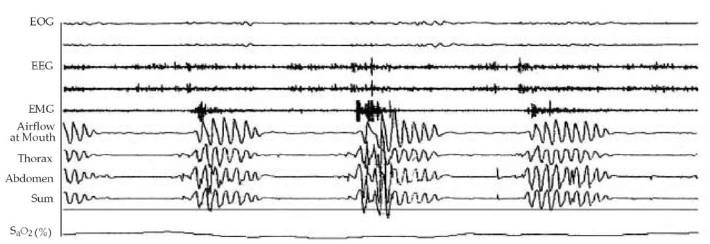  A fragment of a polysomnogram shows a series of central apnea episodes during slow wave sleep. Each episode of absent flow is accompanied by a cessation of thoracoabdominal efforts. Central sleep apnea has this pattern as its signature. 