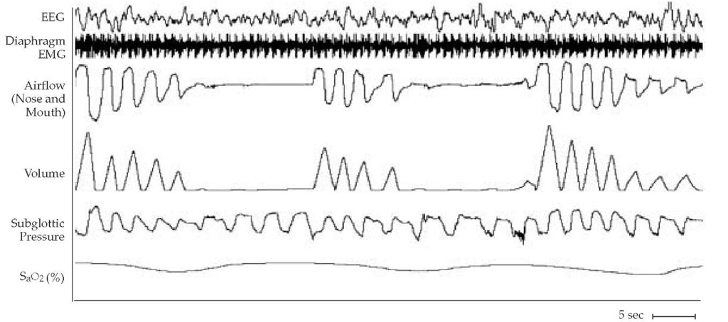 A fragment of a polysomnogram shows a series of obstructive apneas during sleep. Each episode of absent flow is accompanied by continued thoracoabdominal efforts. Apneas are terminated by arousals. Obstructive sleep apnea has this pattern as its signature. 