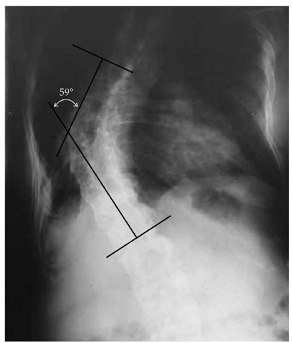In this radiograph of the spine in a patient with kyphoscoliosis, straight lines are passed through the upper and lower limbs of the curvature. The angle inscribed by these two lines defines the scoliotic angle. 