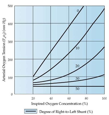 The oxygen concentration of inspired gas is plotted against arterial oxygen tension (Pao2) for right-to-left shunts ranging from 0% to 50% of cardiac output. The arteriovenous oxygen content difference is assumed to be normal. Note that with right-to-left shunts in excess of 30%, there is virtually no increase in PaO2 with oxygen enrichment.  
