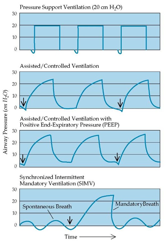 Pressures measured at the endotracheal tube are shown as a function of time to illustrate the effects of various modes of pressure-preset (top panel) or constant tidal volume (bottom three panels) mechanical ventilation. Supra-atmospheric pressures have positive values, whereas subatmospheric pressures have negative values. Arrows indicate initiation of inspiration by the patient, triggering the ventilator to deliver an assisted breath.