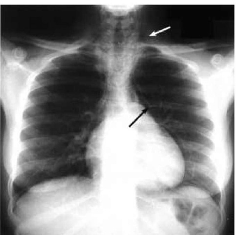 Chest radiograph displays several signs of barotrauma, including subcutaneous emphysema (white arrow) and pneumo-mediastinum (black arrow). 