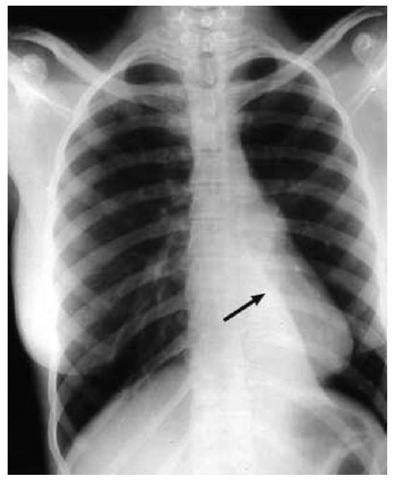 Chest radiograph shows a collapsed left lower lobe of the lung (arrow). 