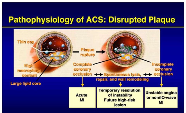 Pathophysiology of ACS:Disrupted Plaque