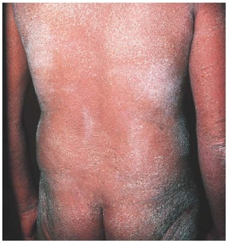 Erythroderma, which appears as total skin erythema and scaling, can occur as a result of papulosquamous and eczematous disorders caused by a variety of diseases. Cutaneous T cell lymphoma, as seen in this patient with Sezary syndrome, can result in erythroderma. 