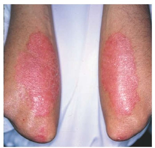 Involvement of the elbows is characteristic of plaque psoriasis. 